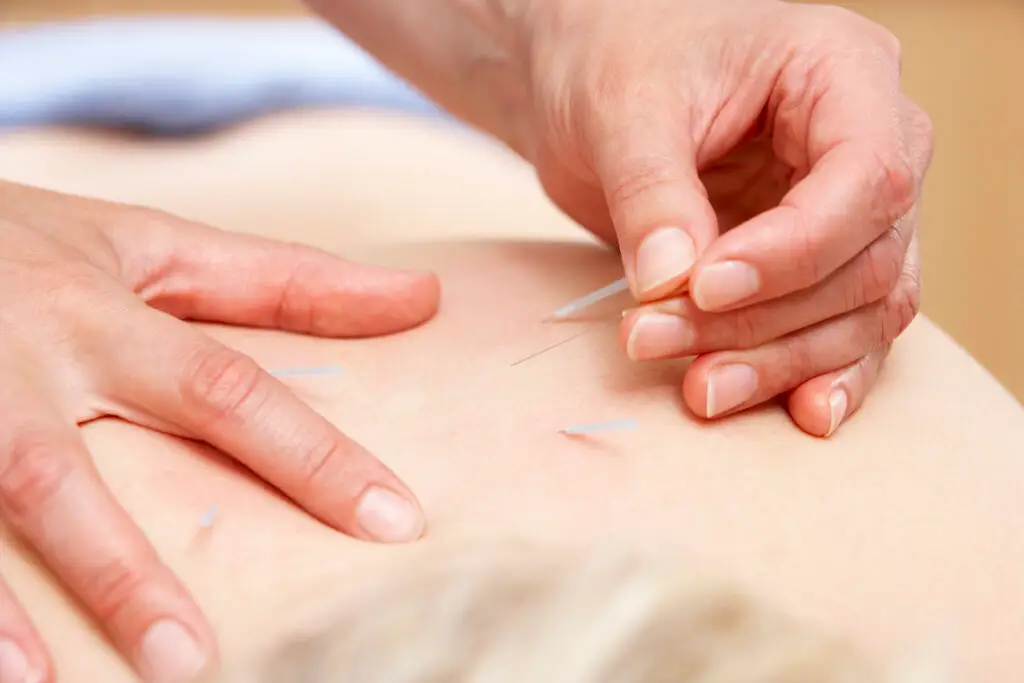 The acupuncturist providing acupuncture in Wesley Chapel for a patient with back pain