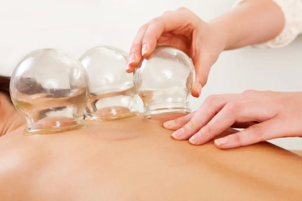 An acupuncturist using cupping therapy to treat back pain